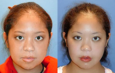 Pediatric Plastic Surgery