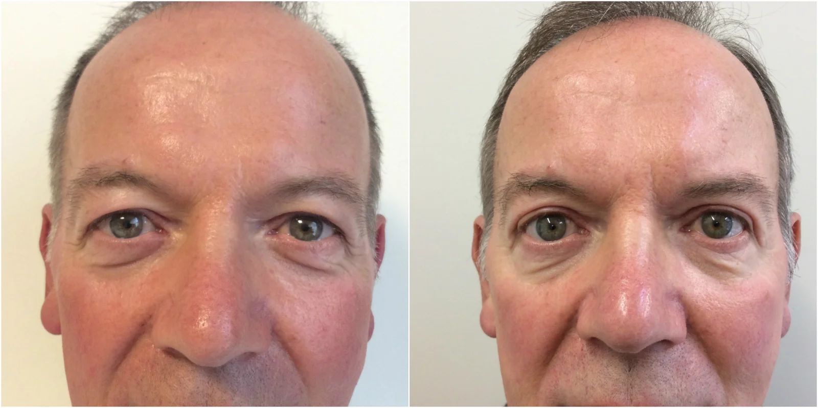 Blepharoplasty (Eyelid Surgery)