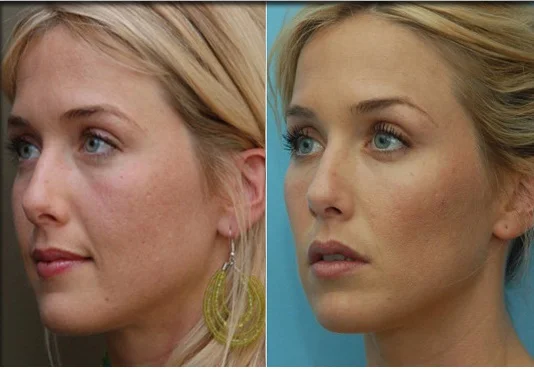 Cheek Augmentation & Implants (Malarplasty)