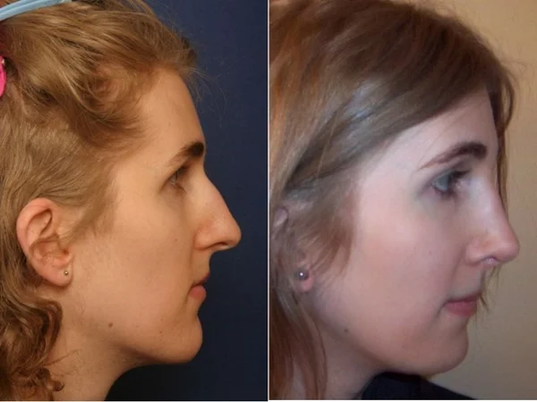 Chin Projection & Lower Face Harmonization