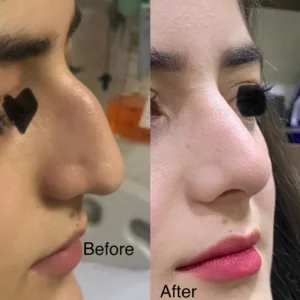 Septo-Rhinoplasty & Deviated Septum